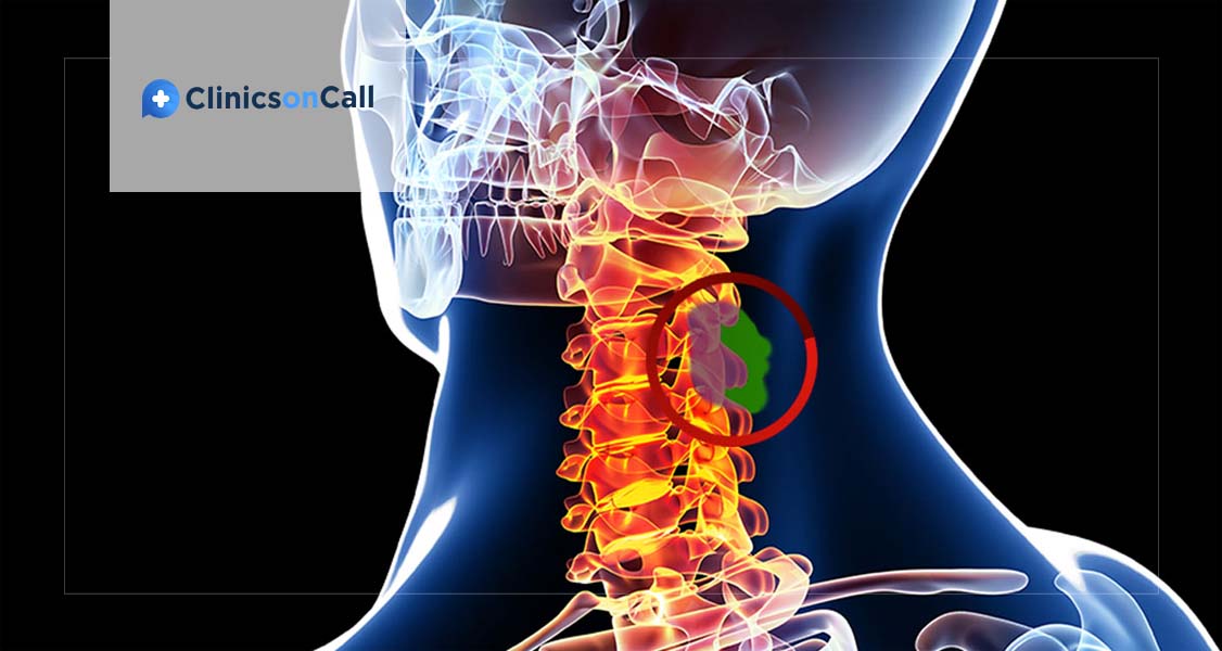 Diagnosis & Treatment of Vertebral Tumor in Foreign Clinics