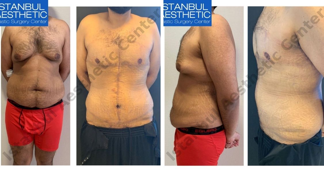 Before & After Pictures of Abdominoplasty at Istanbul Aesthetic Center