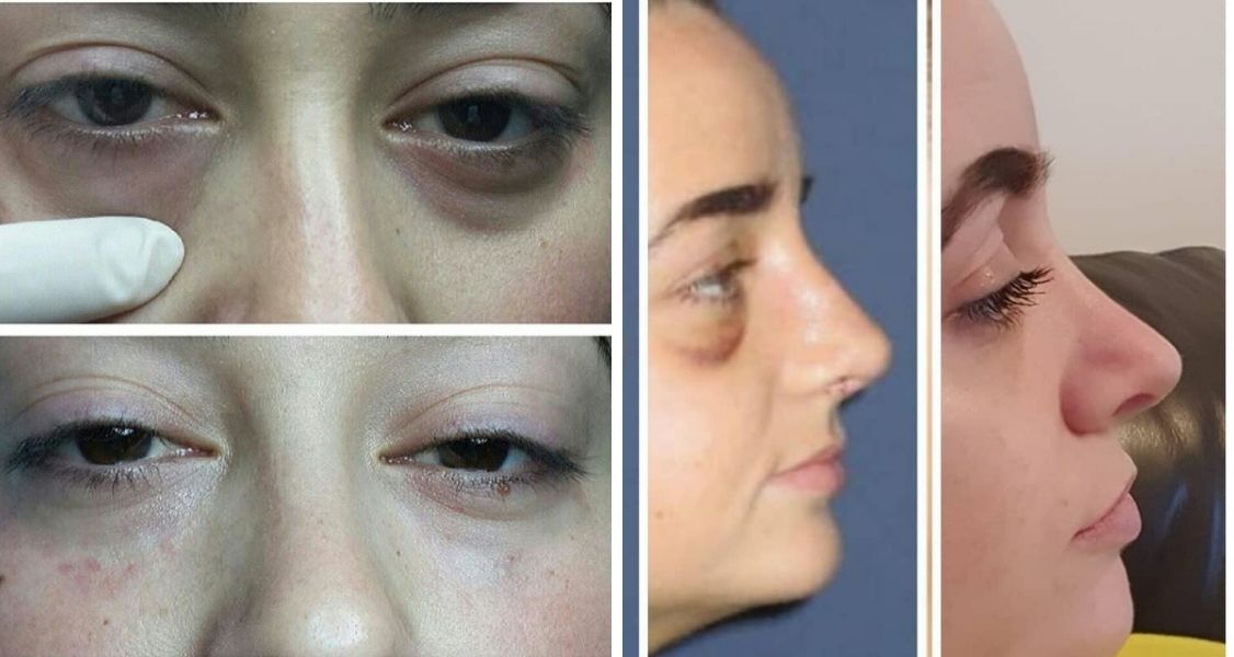 Before & After Pictures of Blepharoplasty at Istanbul Aesthetic Center