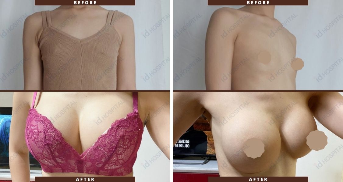 Before & After Pictures of Breast Augmentation at ID Hospital