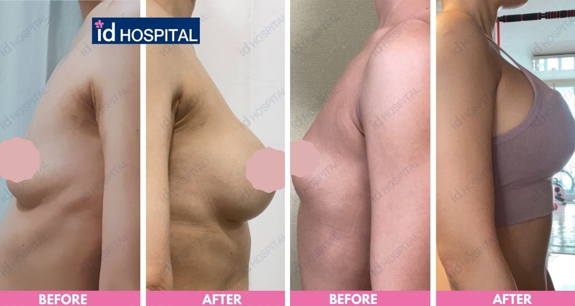 Before & After Pictures of Breast Augmentation with implants at ID Hospital