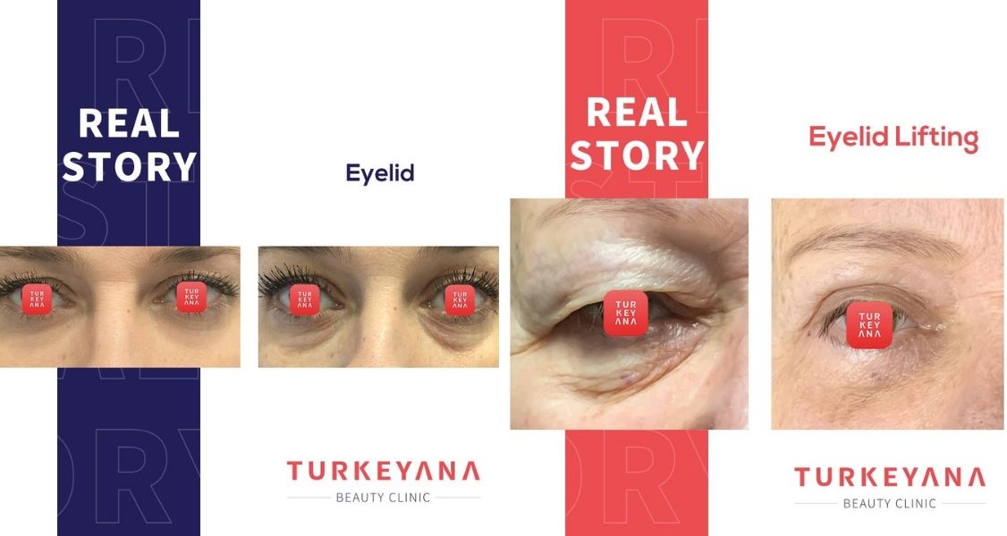 Before & After Pictures of Eyelid Lifting at Turkeyana Clinic