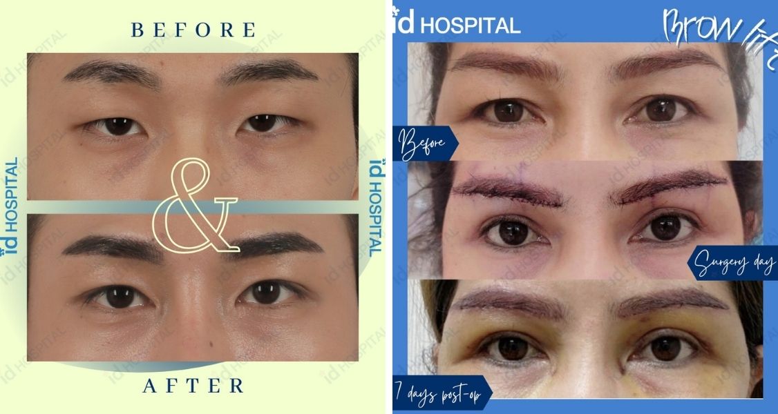 Before & After Pictures of Eyelid Surgery at ID Hospital