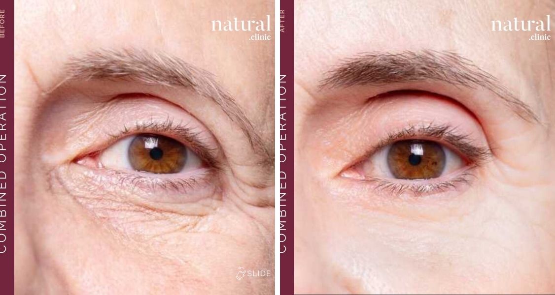 Before & After Pictures of Eyelid Surgery at Natural Clinic