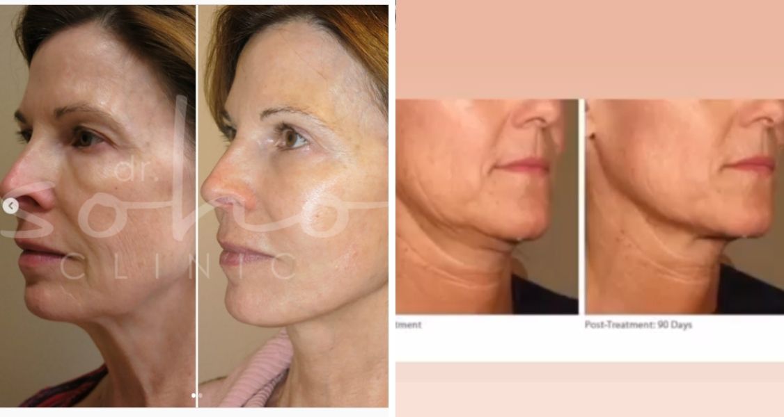 Before & After Pictures of Facelift at Dr. Soho Clinic