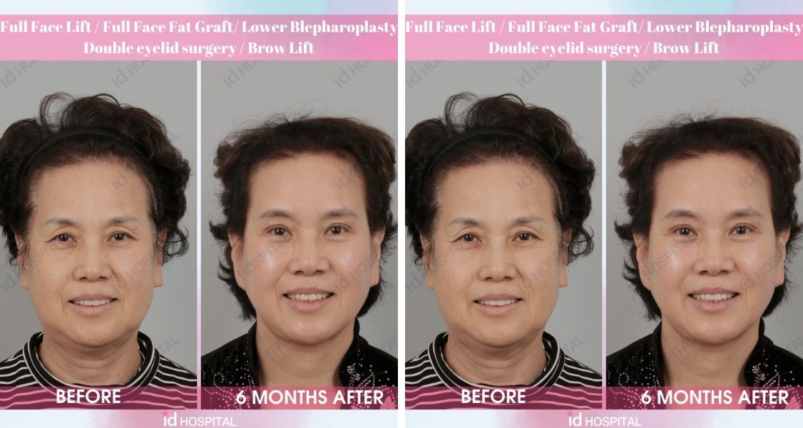 Before & After Pictures of Facelift & Blepharoplasty at ID Hospital