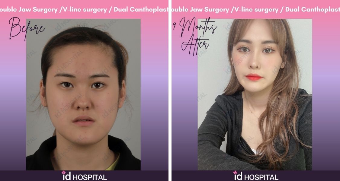 Before & After Pictures of Facial Aesthetics (Double Jaw Surgery, V line Surgery) ) at ID Hospital