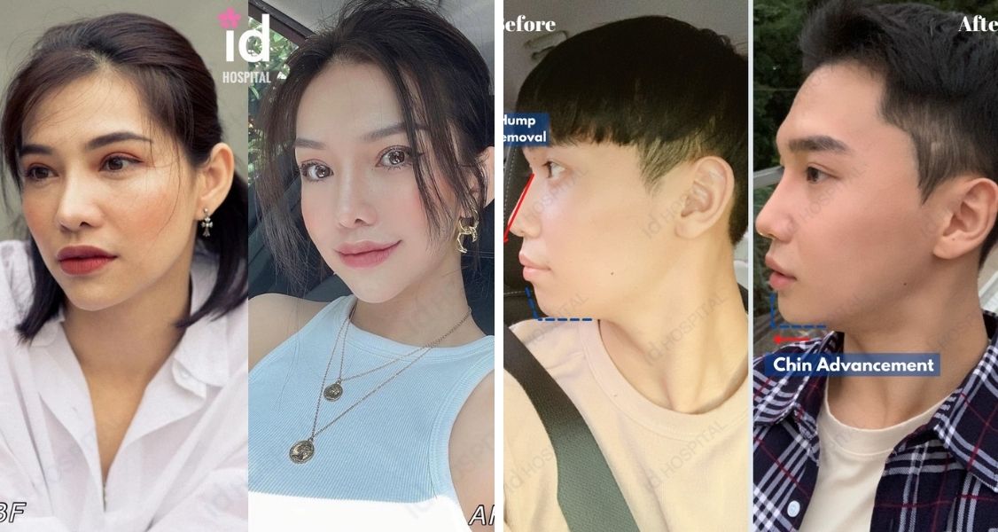 Before & After Pictures of Facial Aesthetics (Mentoplasty, Rhinoplasty, V-line Surgery, Cheekbone Reduction, Thread Lift, Fat graft ) at ID Hospital