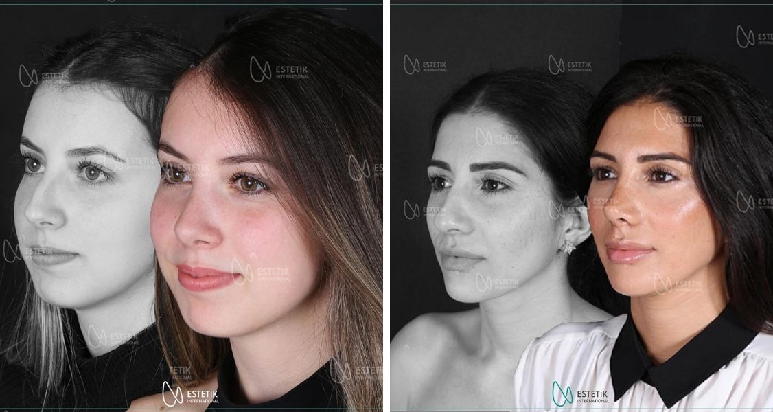 Before & After Pictures of Rhinoplasty at Estetik International Istanbul