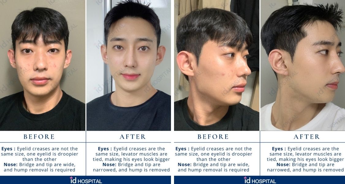 Before & After Pictures of Rhinoplasty & Eyelid Surgery at ID Hospital
