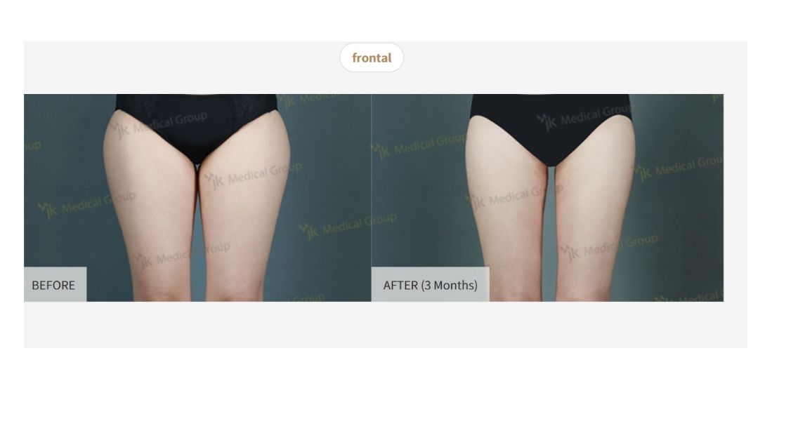 Before & After Pictures of 3D Liposuction at JK Clinic