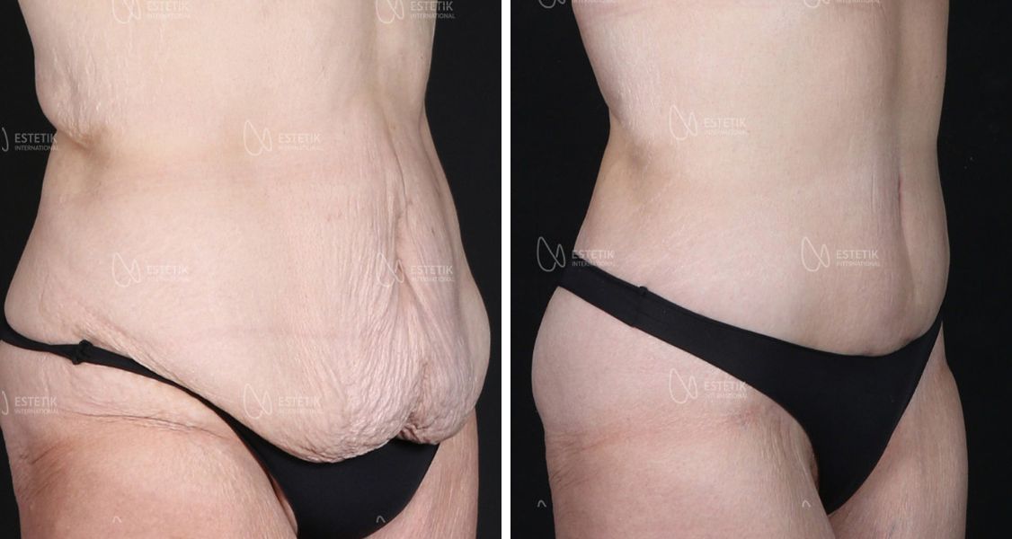 Before & After Pictures of Abdominoplasty at Estetik International