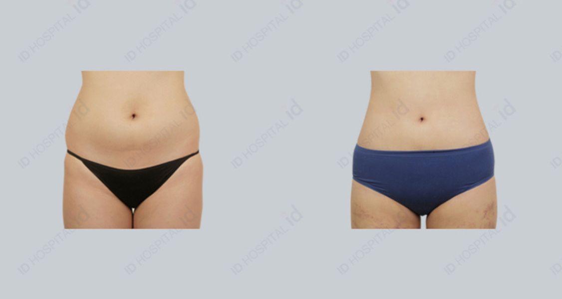 Before & After Pictures of Abdominoplasty at ID Plastic Surgery Center