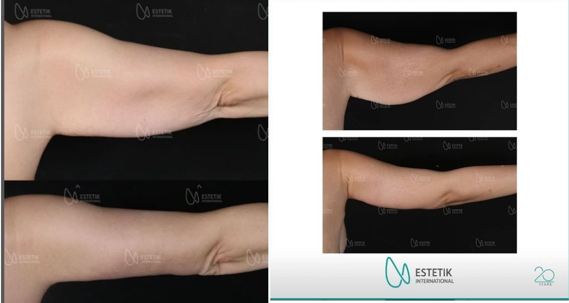 Before & After Pictures of ArmLift by Dr. Selcuk AytacBefore & After Pictures of ArmLift by Dr. Selcuk Aytac