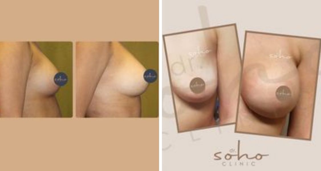 Before & After Pictures of Breast Augmentation at Dr. Soho