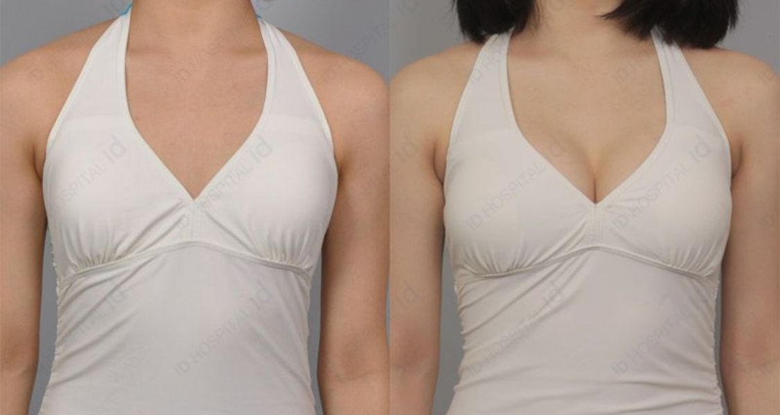 Before & After Pictures of Breast Augmentation at ID Hospital