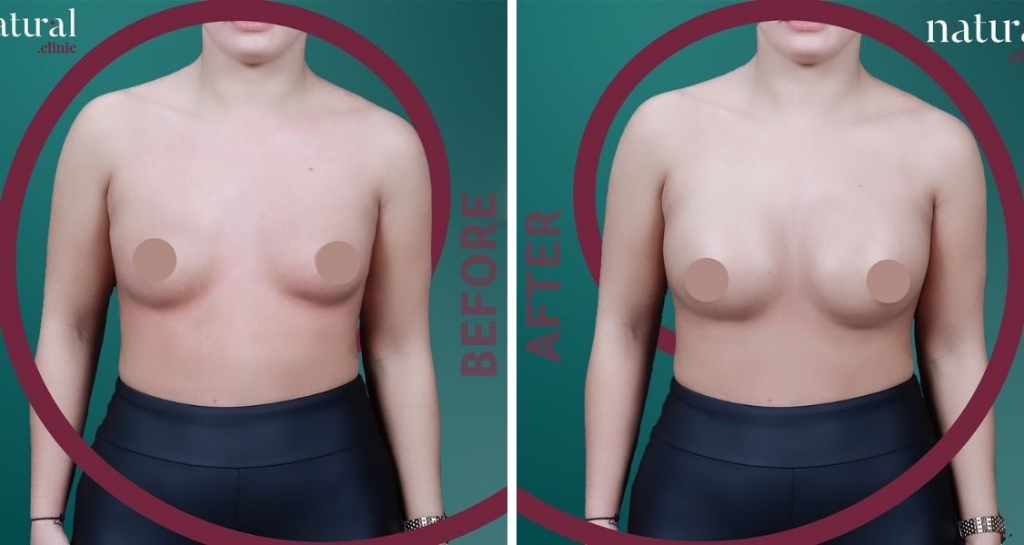 Before & After Pictures of Breast Augmentation at Natural Clinic Turkey
