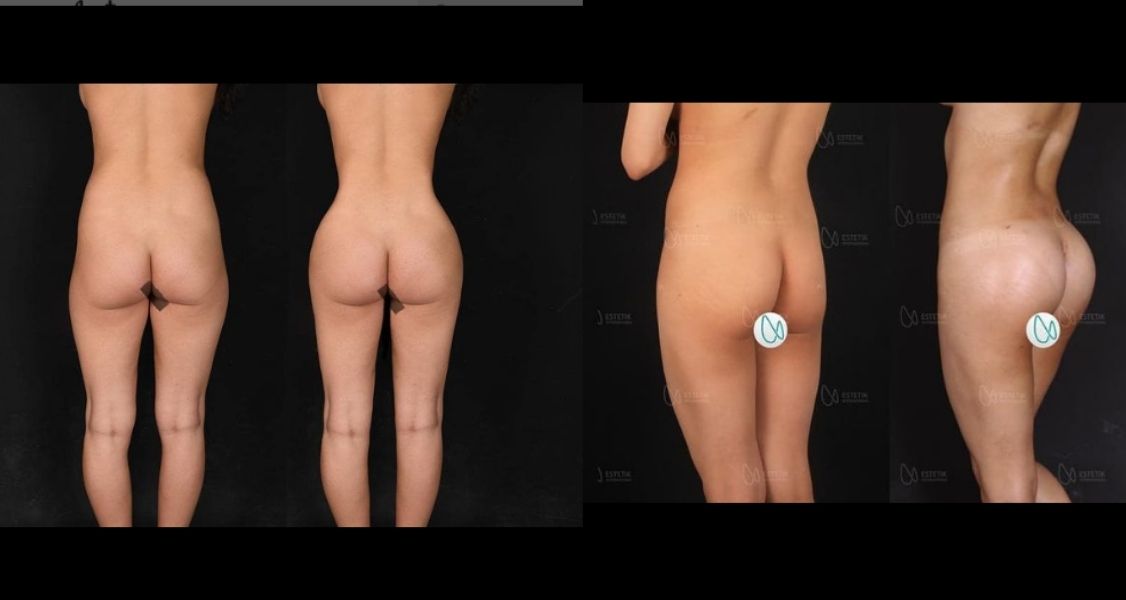 Before & After Pictures of Butt Lift by Dr. Selcuk Aytac