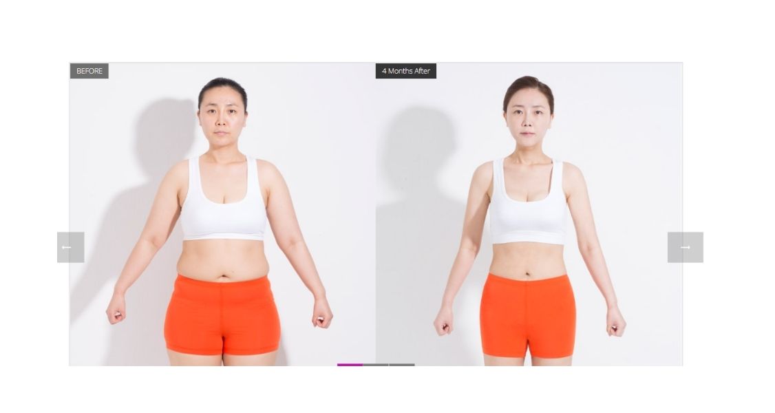 Before & After Pictures of Full Body Liposuction at Banobagi