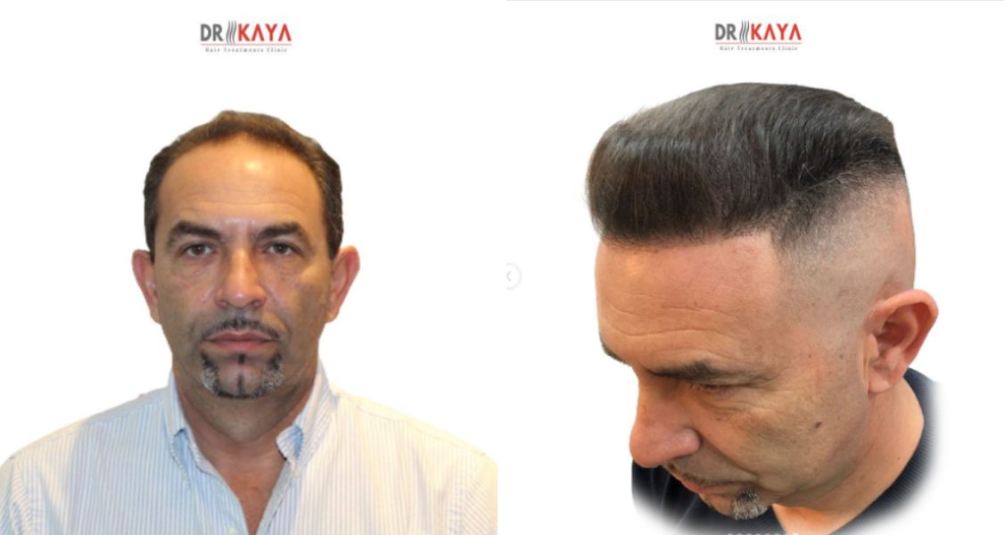 Before & After Pictures of Hair Transplant- Dr. Mahmut Alan Kaya (4)