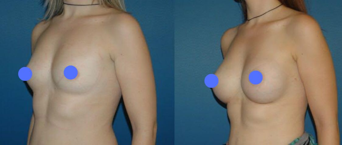 Before & After Pictures Breast Augmentation with implants