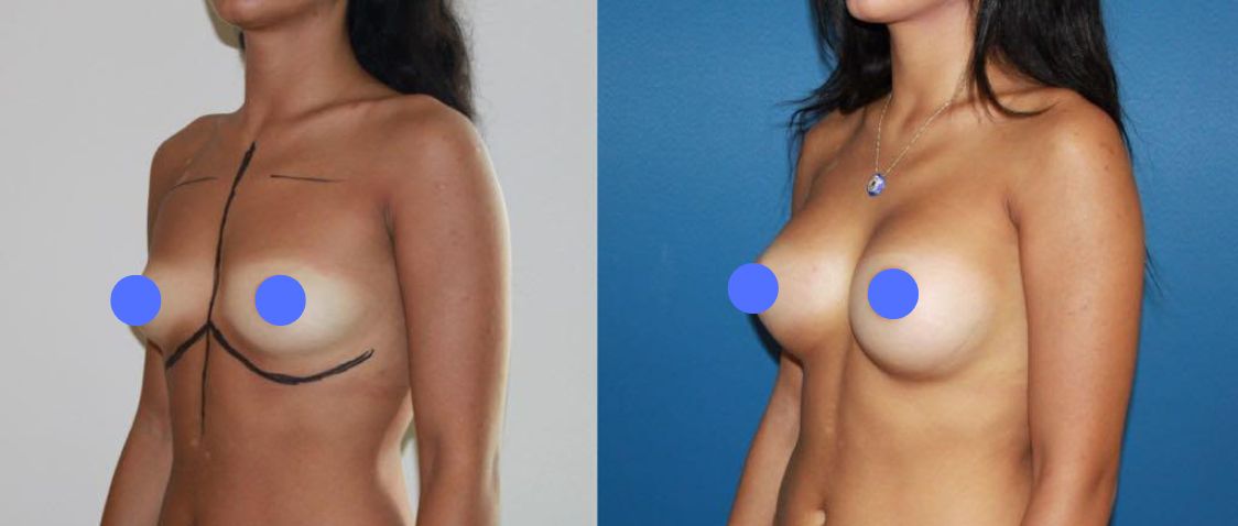 Before & After Pictures Breast Augmentation with implants