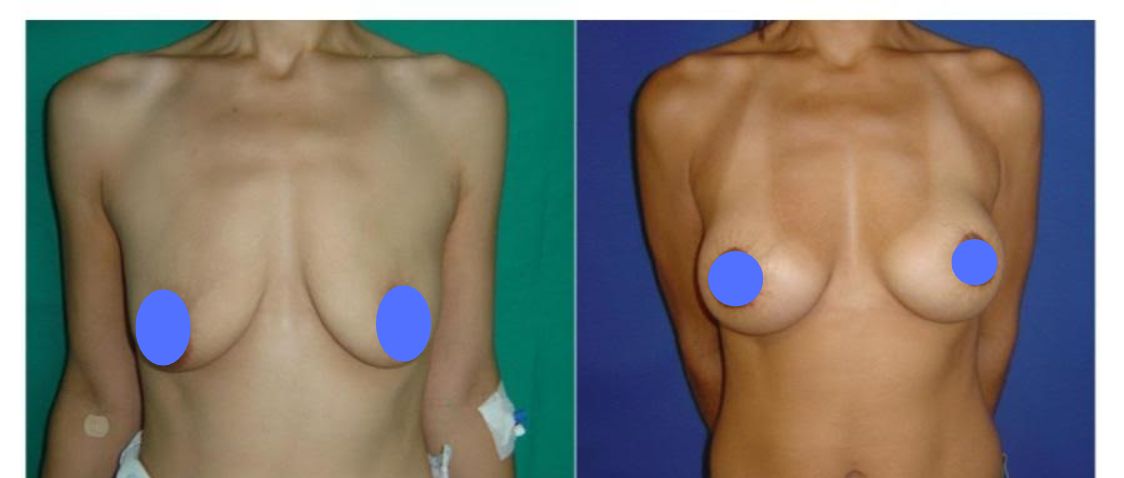 Before & After Pictures Breast Lift