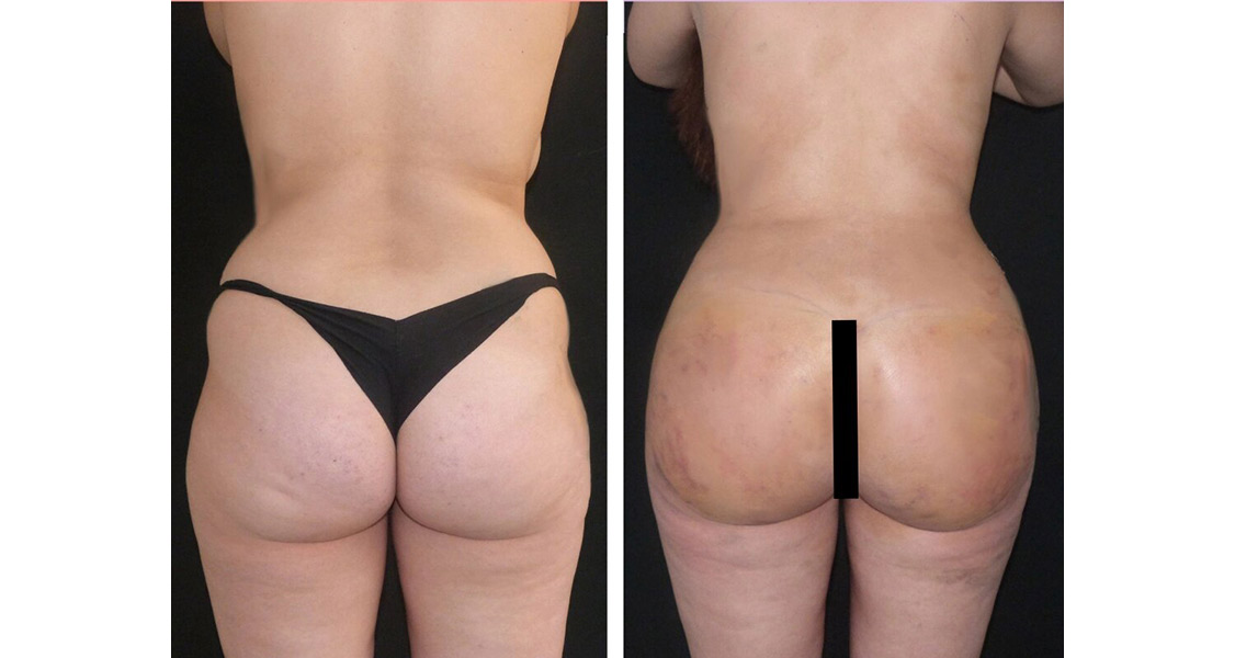 Липосакция ягодиц в клиниках Турции Липосакция ягодиц в клиниках Турции