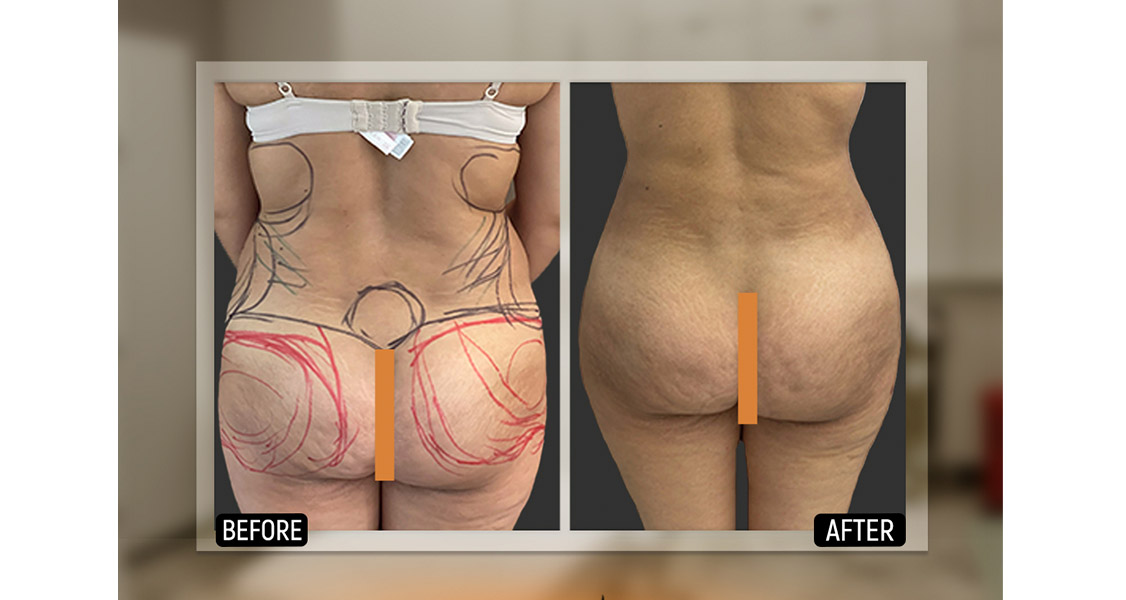 Липосакция ягодиц в Турции Липосакция ягодиц в Турции