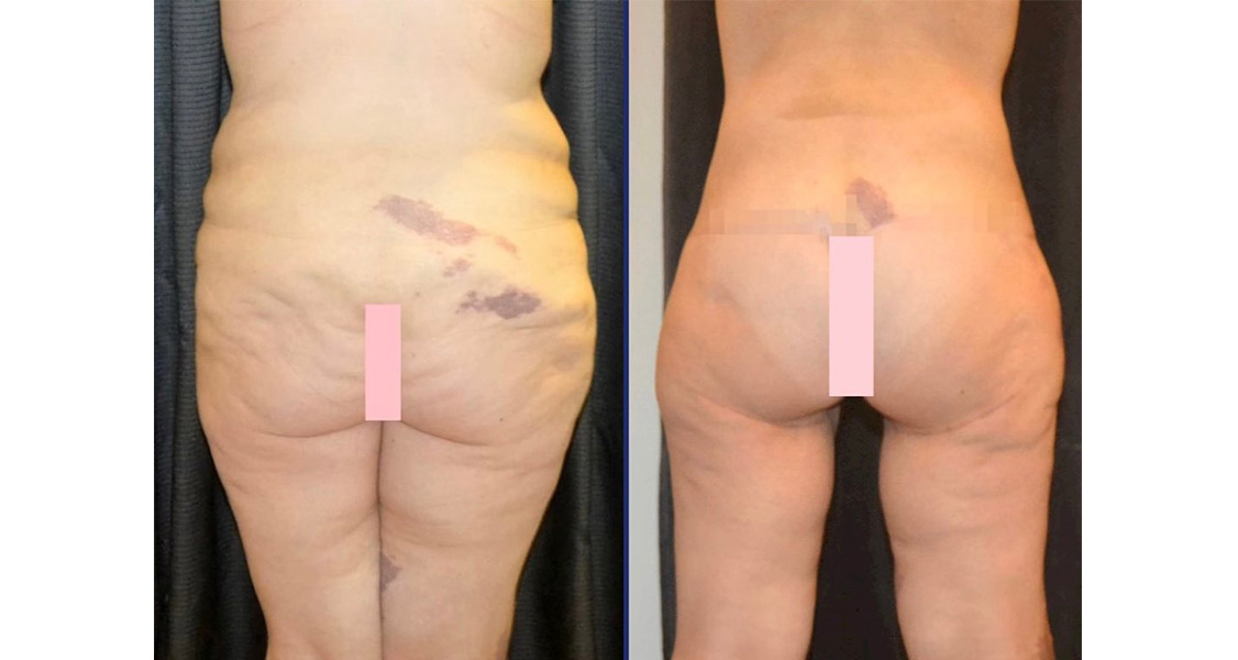 Уменьшение ягодиц липосакцией в Турции Уменьшение ягодиц липосакцией в Турции