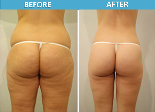 Липосакция ягодиц