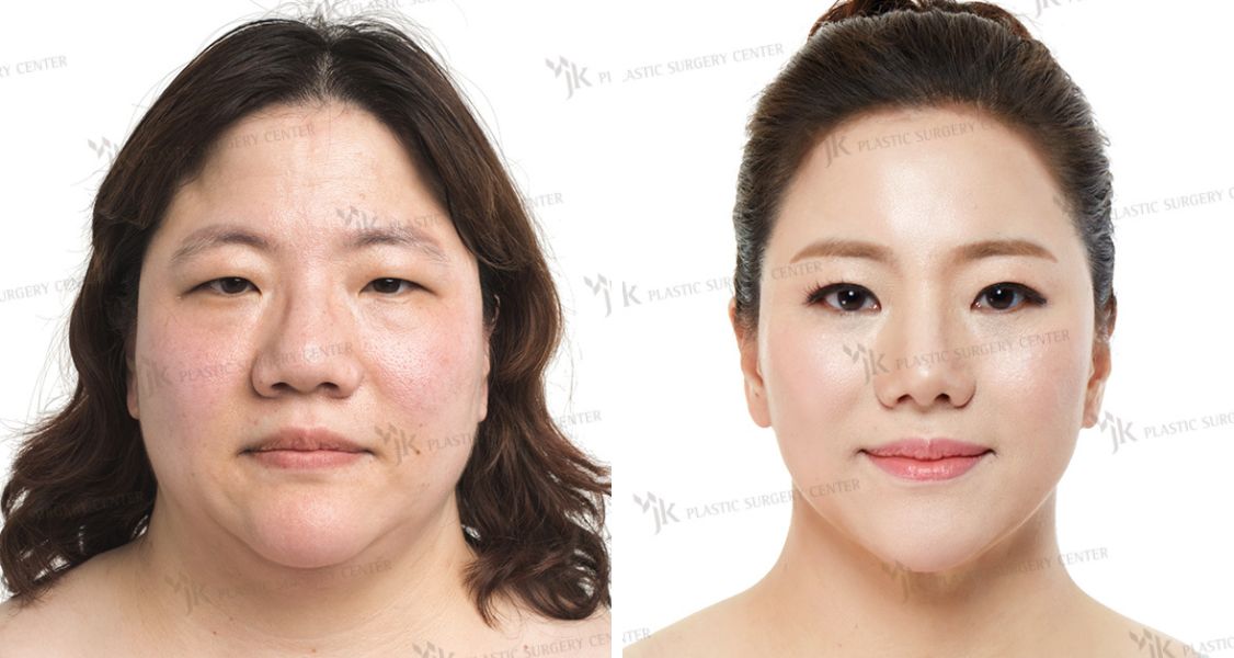 https://clinicsoncall.com/wp-content/uploads/2023/02/before-after-pictures-of-facelift-11.jpg