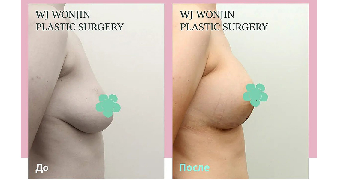 Подтяжка груди с увеличением имплантом в Южной Корее