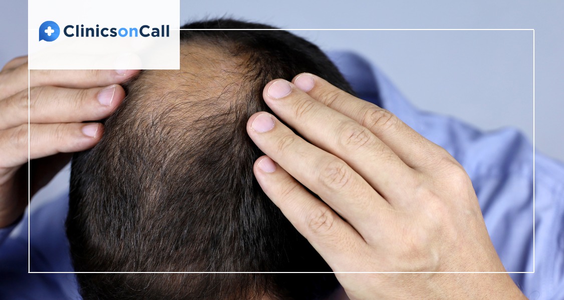 пересадки волосся FUT