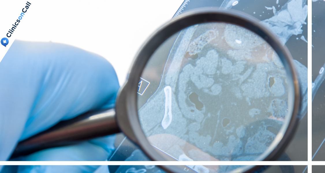 Выявление рака прямой кишки в Грузии