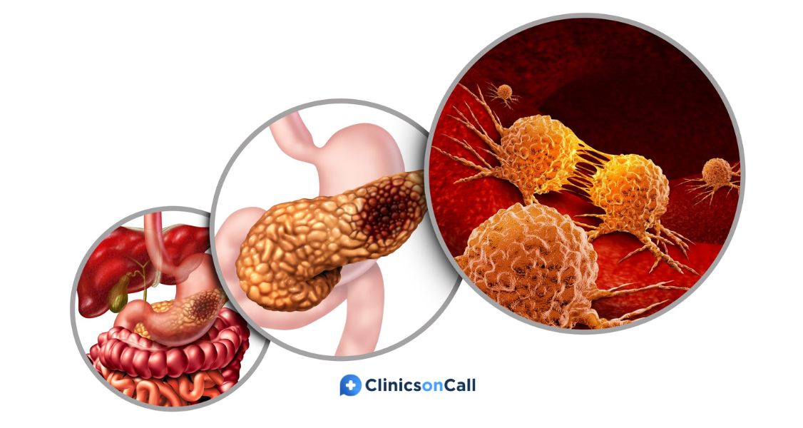 Опухоль поджелудочной железы